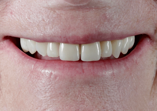 After - Burgate Dental Practice & Implant Centre