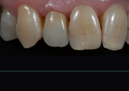 After - Burgate Dental Practice & Implant Centre