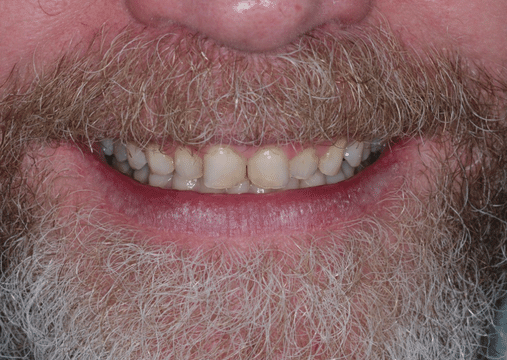 Before - Burgate Dental Practice & Implant Centre