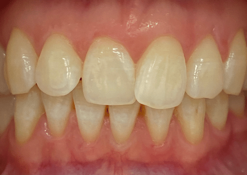 Before - Burgate Dental Practice & Implant Centre