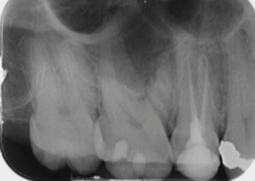 Before - Burgate Dental Practice & Implant Centre